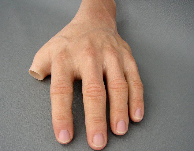 手指假肢價格安裝假肢需要花費多少錢(圖1) 手指假肢價格安裝假肢需要花費多少錢(圖1)