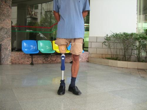 假肢制作流程的詳細闡述(圖1) 假肢